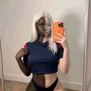 Woman living with vitiligo goes viral, celebrating her unique beauty and personal journey.