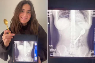 Woman Swallows Spoon After Dog Jumpstart